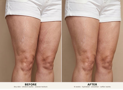 Firm and Fade Cream For Stretch Marks &amp; Tight Skin | PH Design Organics